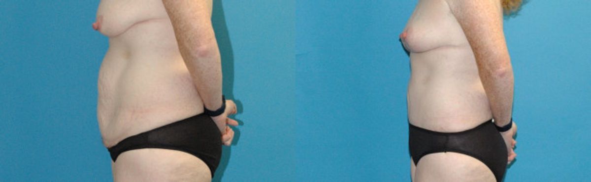 Tummy Tuck #48 - Before and After