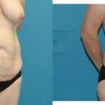 Tummy Tuck #48 - Before and After