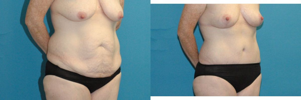 Tummy Tuck #48 - Before and After