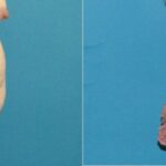 Tummy Tuck #48 - Before and After