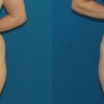 Tummy Tuck #49 - Before and After