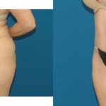Tummy Tuck #49 - Before and After