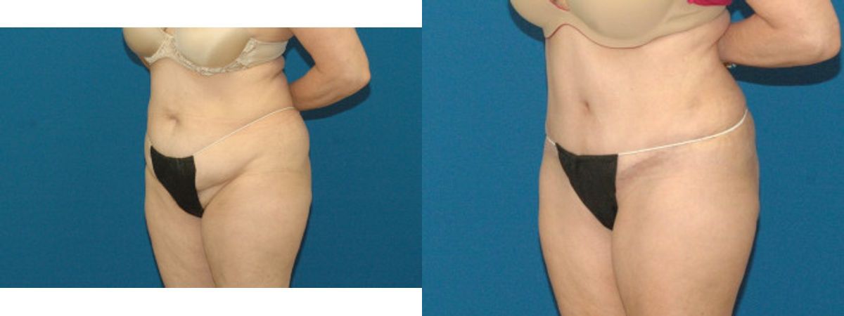 Tummy Tuck #49 - Before and After