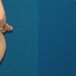 Tummy Tuck #49 - Before and After