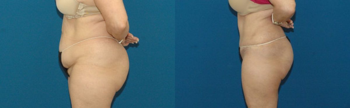 Tummy Tuck #49 - Before and After