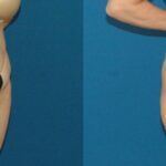 Tummy Tuck #49 - Before and After