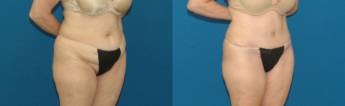 Tummy Tuck #49 - Before and After