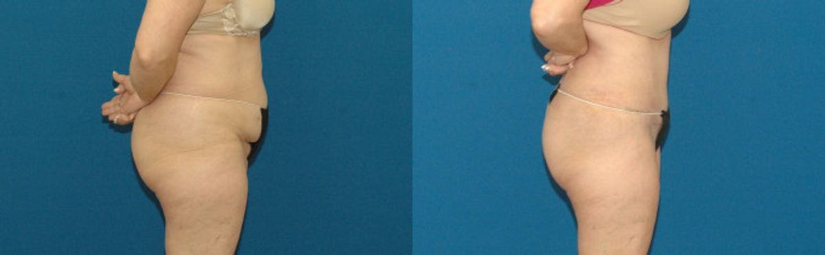 Tummy Tuck #49 - Before and After