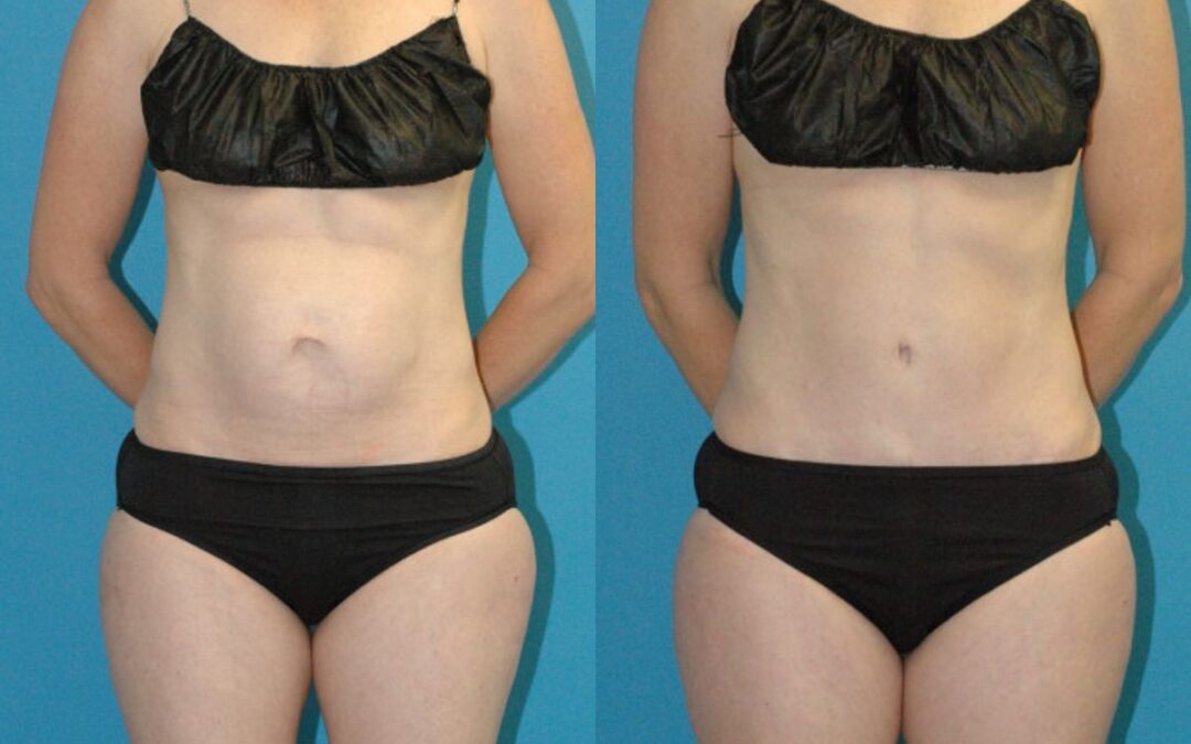 Tummy Tuck #50