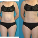 Tummy Tuck #50 - Before and After