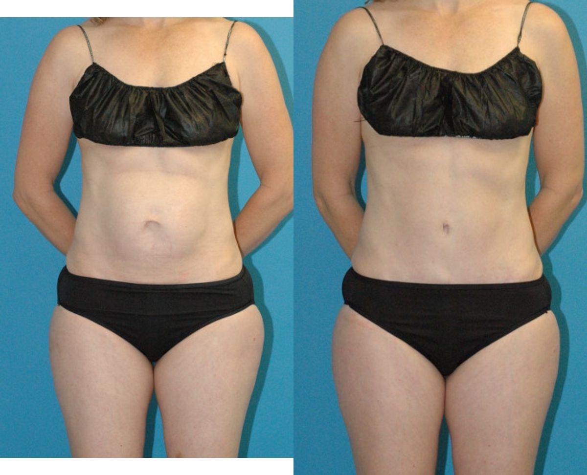 Tummy Tuck #50 - Before and After