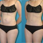 Tummy Tuck #50 - Before and After