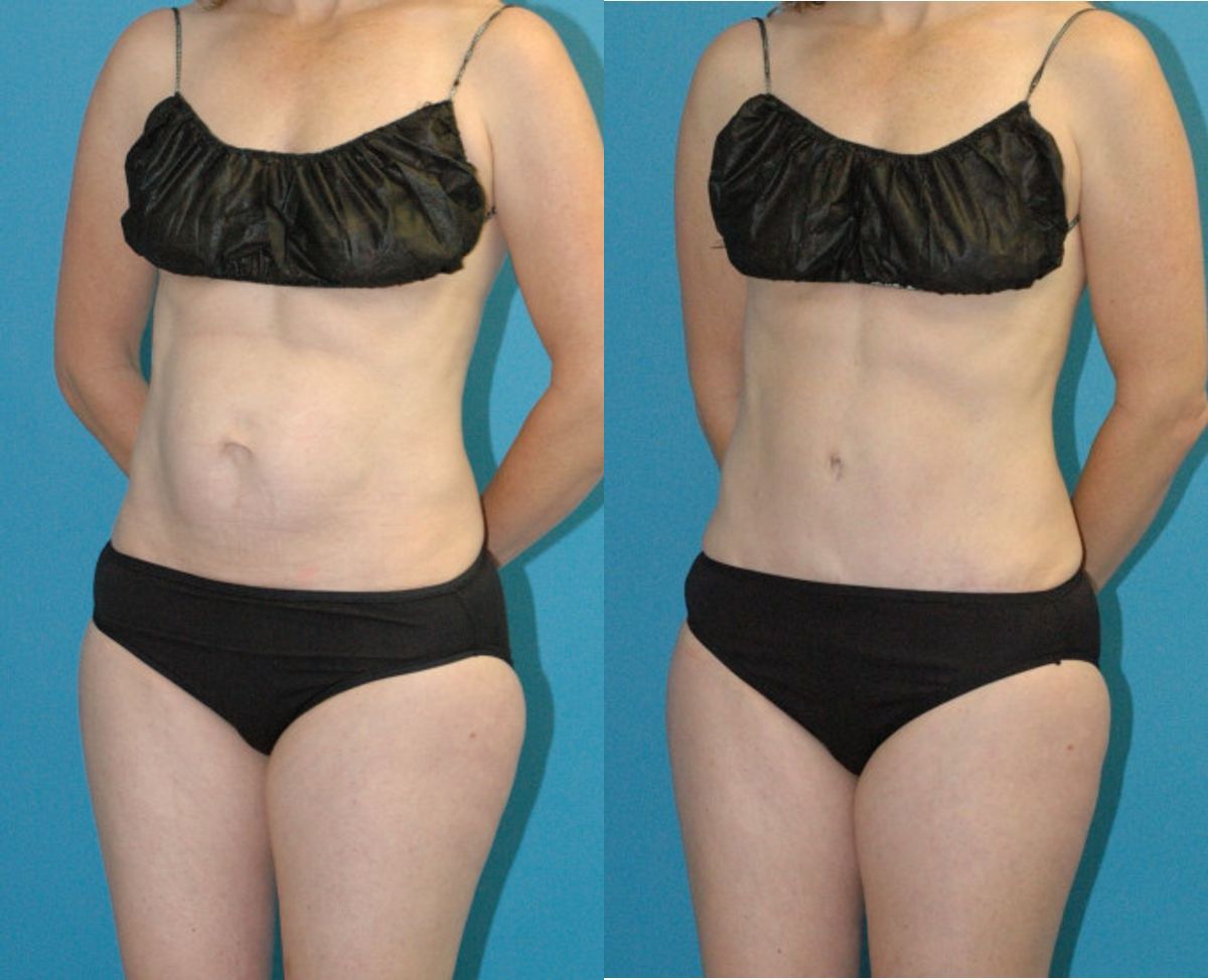 Tummy Tuck #50 - Before and After