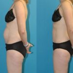 Tummy Tuck #50 - Before and After
