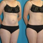 Tummy Tuck #50 - Before and After