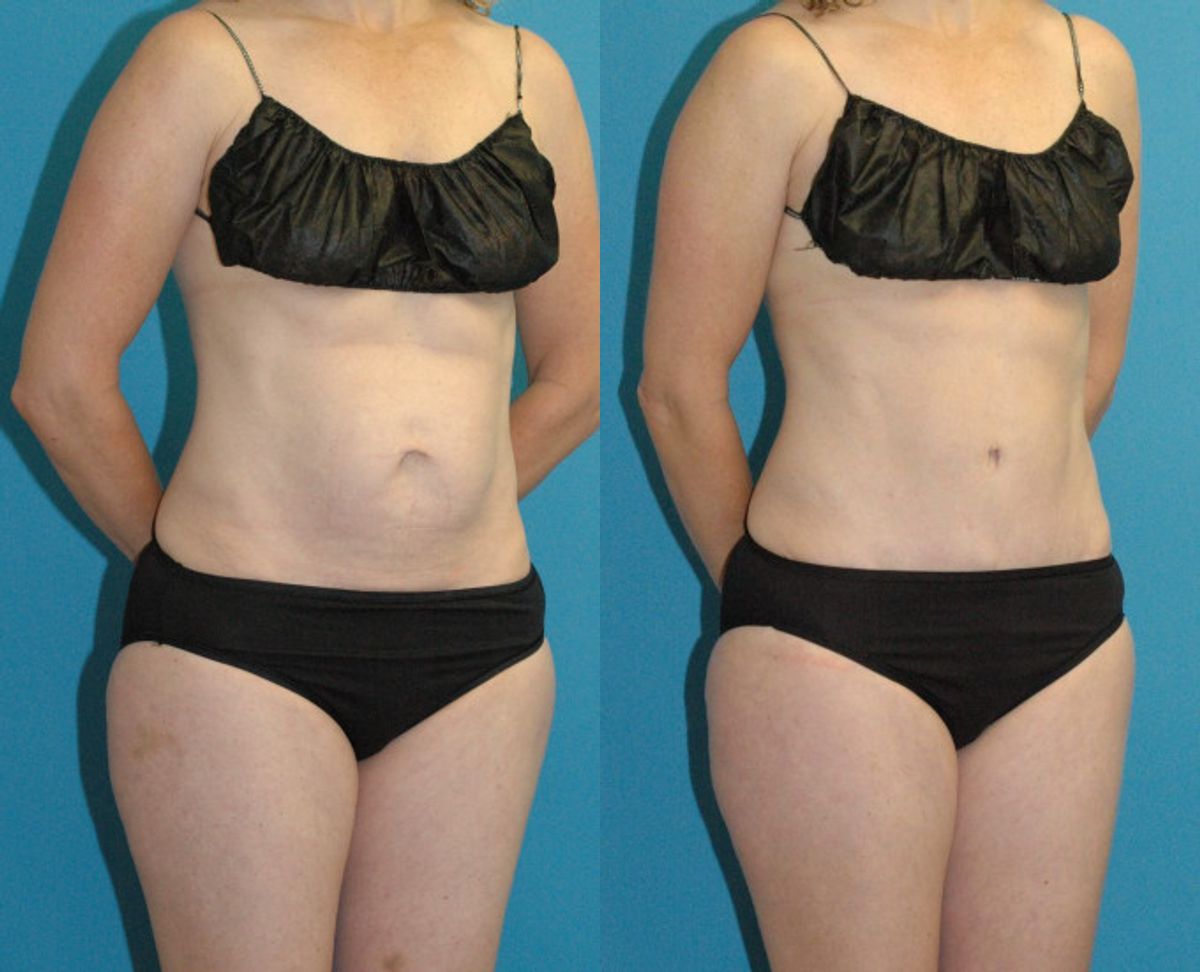 Tummy Tuck #50 - Before and After