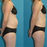 Tummy Tuck #50 - Before and After