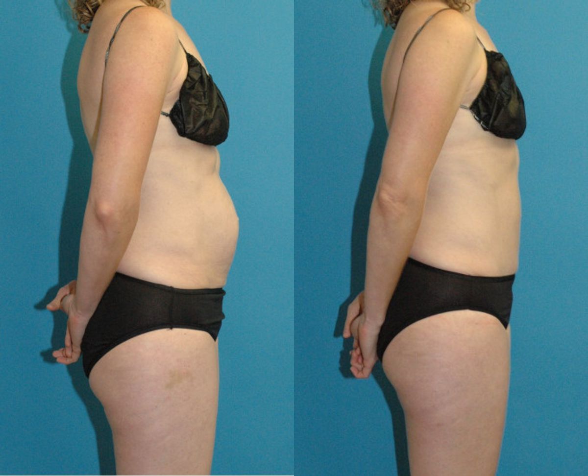 Tummy Tuck #50 - Before and After