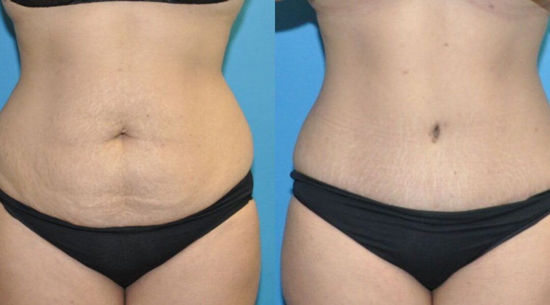Tummy Tuck #51