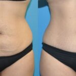 Tummy Tuck #51 - Before and After