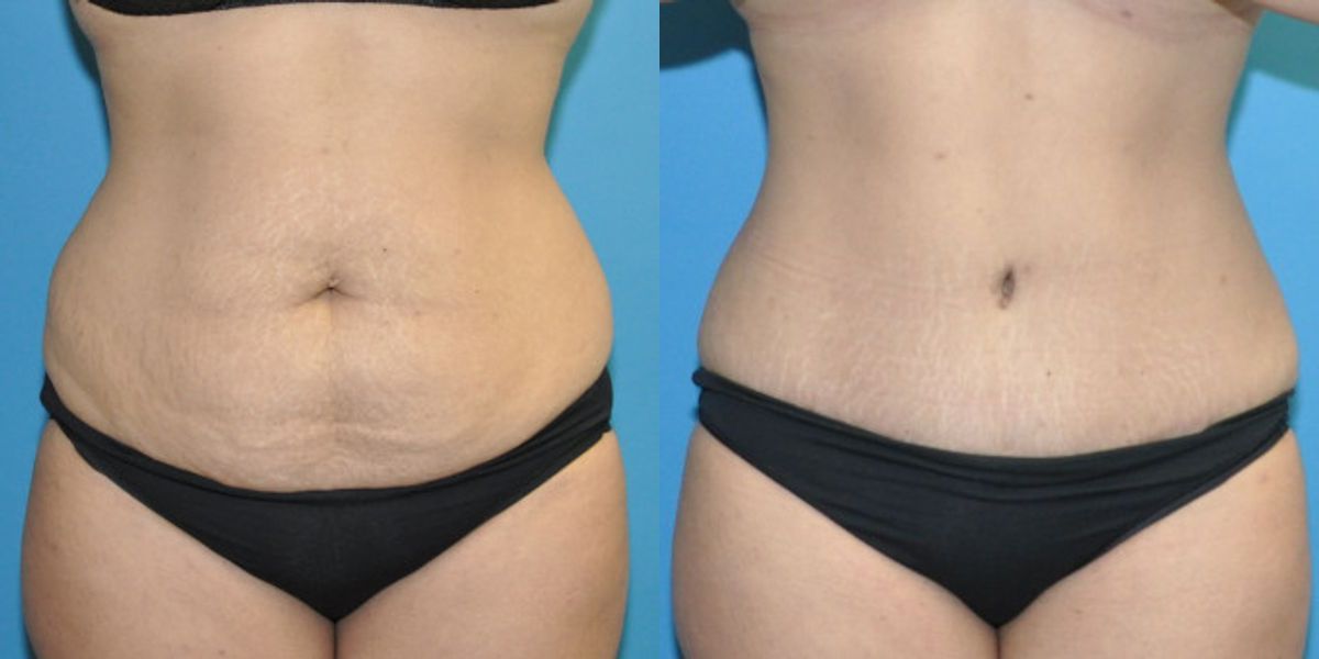 Tummy Tuck #51 - Before and After