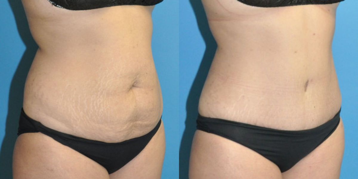 Tummy Tuck #51 - Before and After