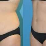 Tummy Tuck #51 - Before and After