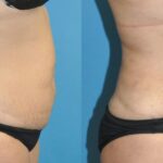 Tummy Tuck #51 - Before and After