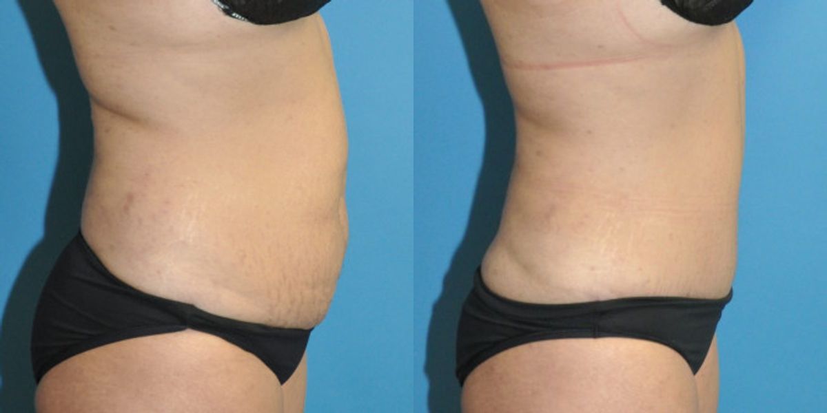 Tummy Tuck #51 - Before and After