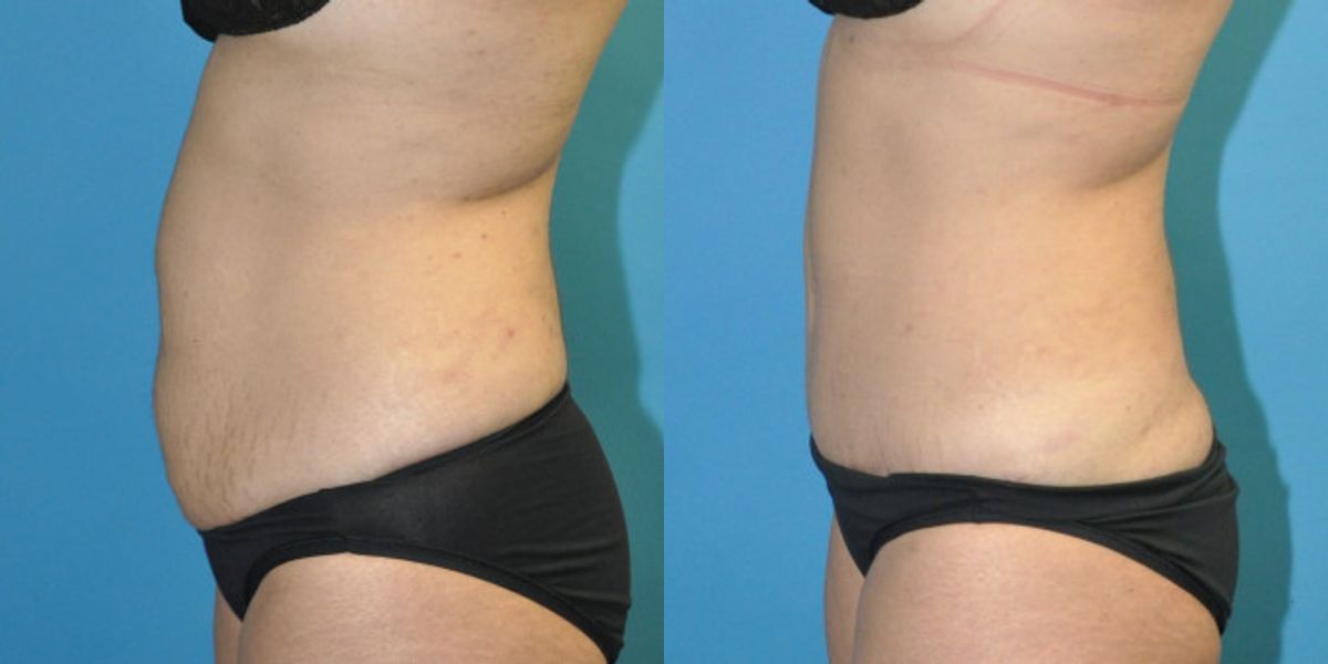 Tummy Tuck #51 - Before and After