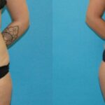 Tummy Tuck #52 - Before and After