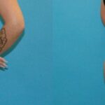 Tummy Tuck #52 - Before and After