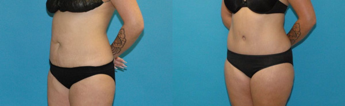 Tummy Tuck #52 - Before and After