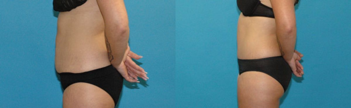 Tummy Tuck #52 - Before and After