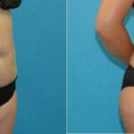 Tummy Tuck #52 - Before and After