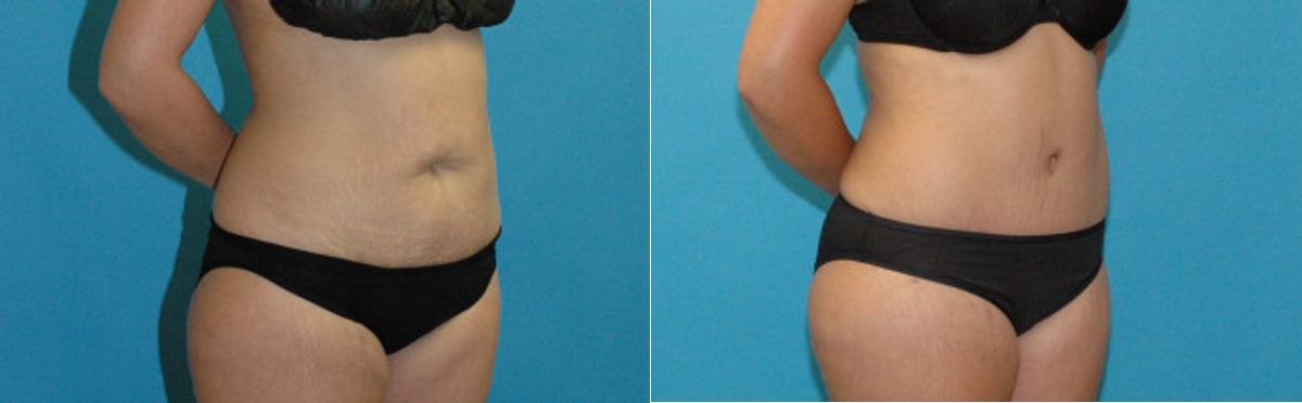 Tummy Tuck #52 - Before and After