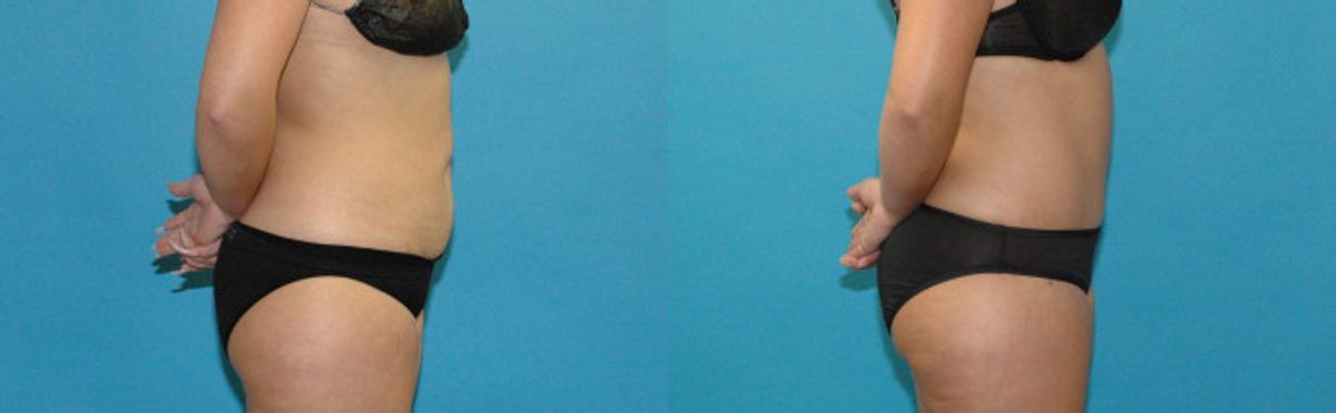 Tummy Tuck #52 - Before and After