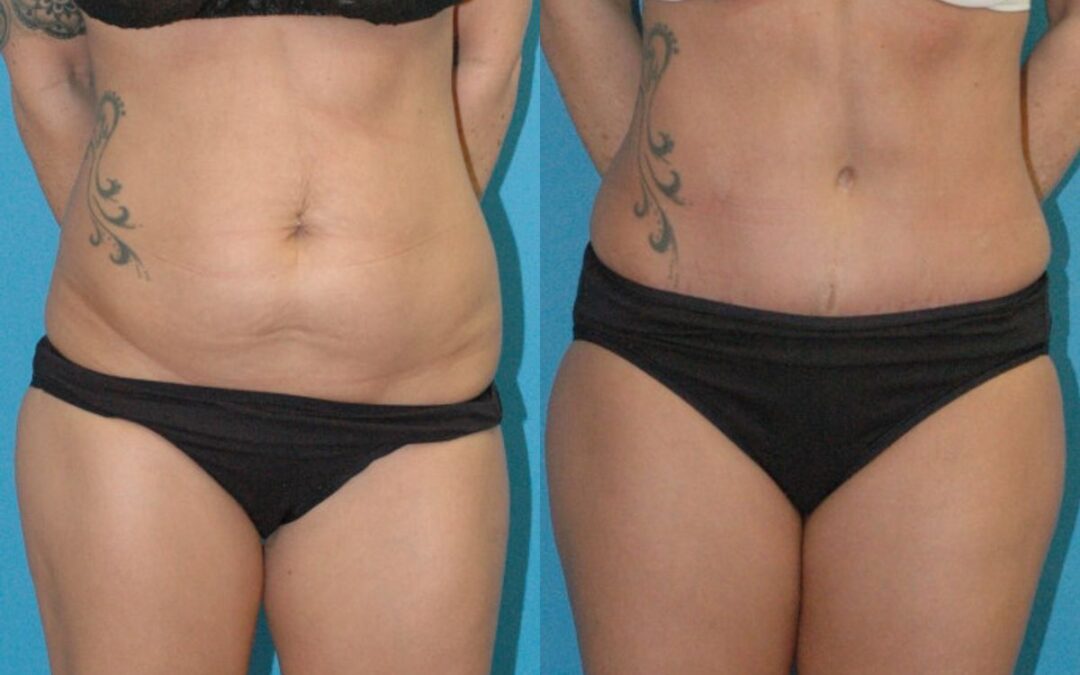 Tummy Tuck #53