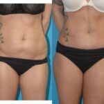 Tummy Tuck #53 - Before and After