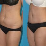 Tummy Tuck #53 - Before and After