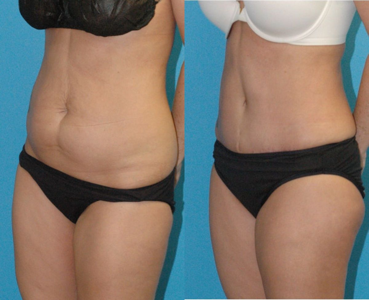 Tummy Tuck #53 - Before and After