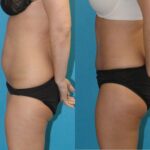 Tummy Tuck #53 - Before and After