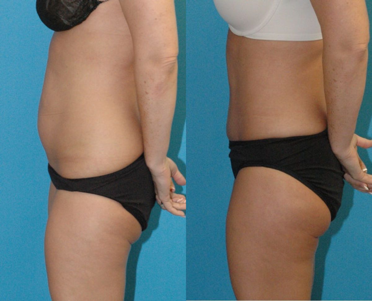 Tummy Tuck #53 - Before and After