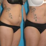 Tummy Tuck #53 - Before and After