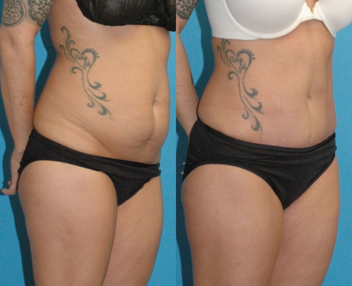 Tummy Tuck #53 - Before and After