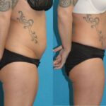 Tummy Tuck #53 - Before and After