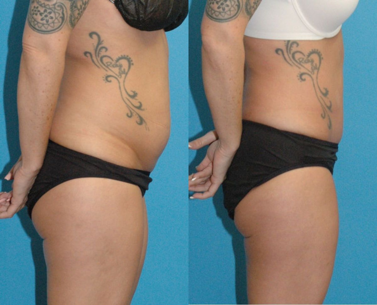 Tummy Tuck #53 - Before and After