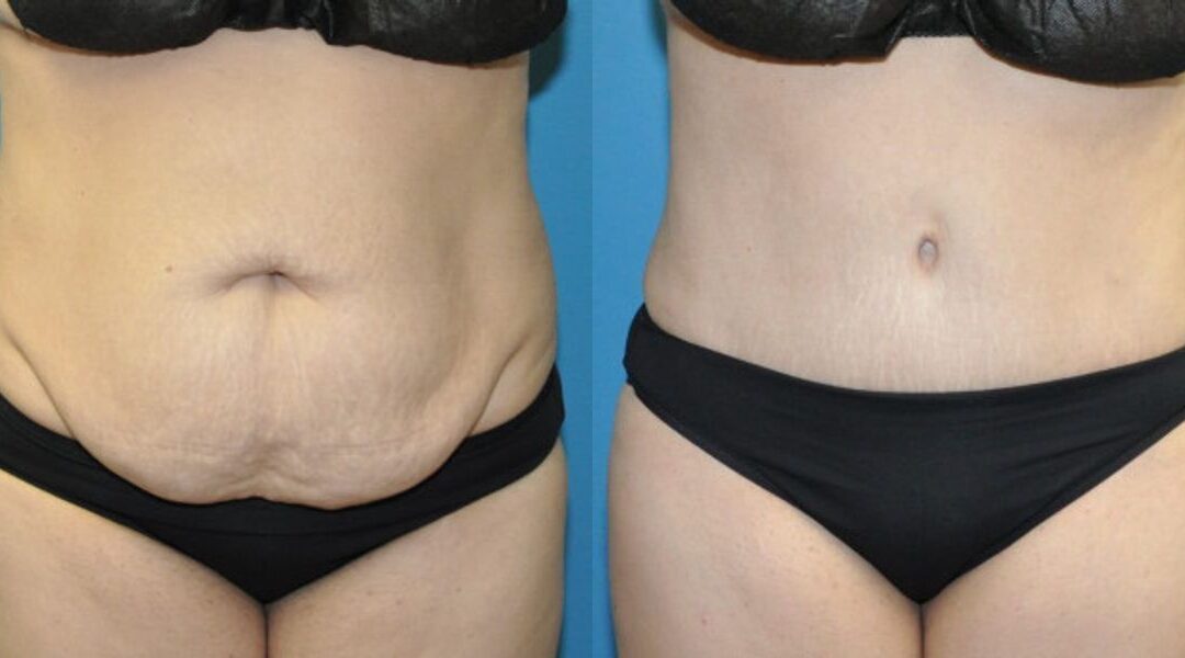 Tummy Tuck #54
