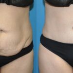 Tummy Tuck #54 - Before and After