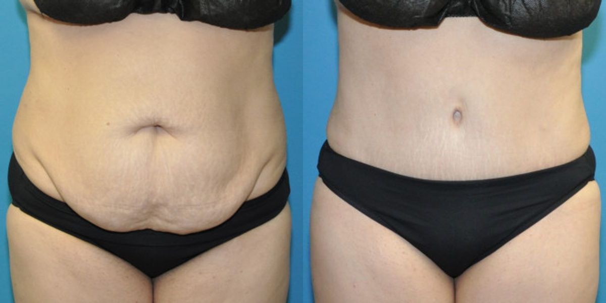 Tummy Tuck #54 - Before and After